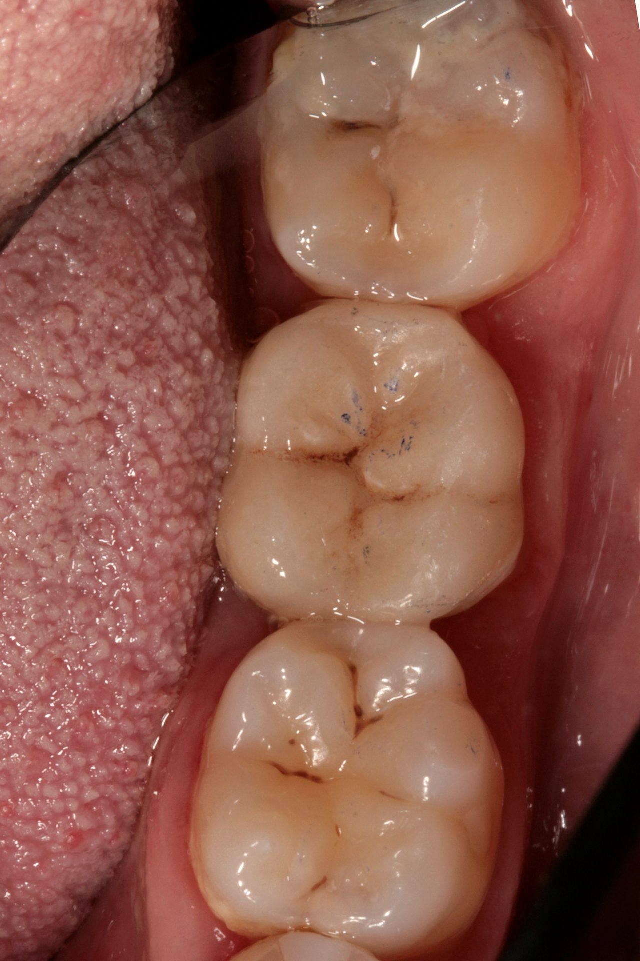 Dopo — Intarsio · caso clinico Dental3N