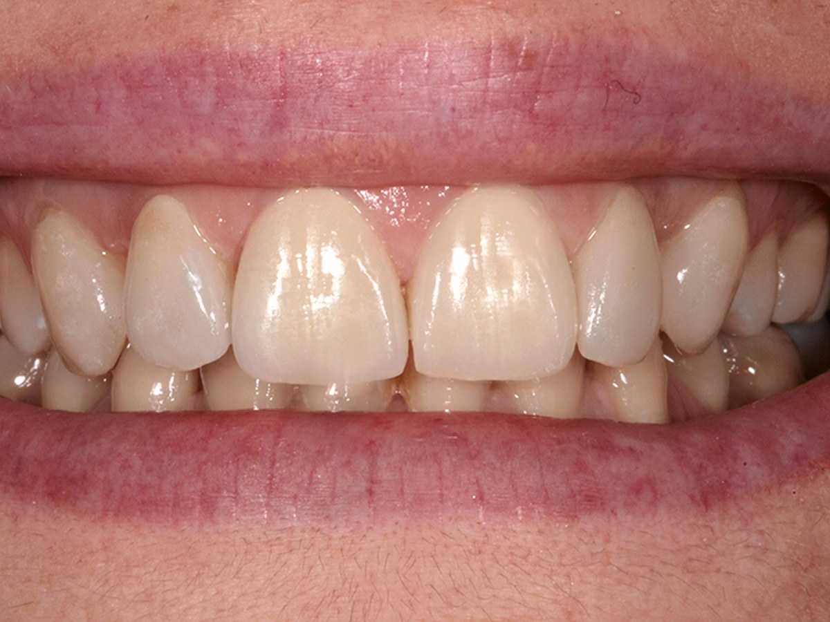 Dopo — Faccette in ceramica · caso clinico Dental3N