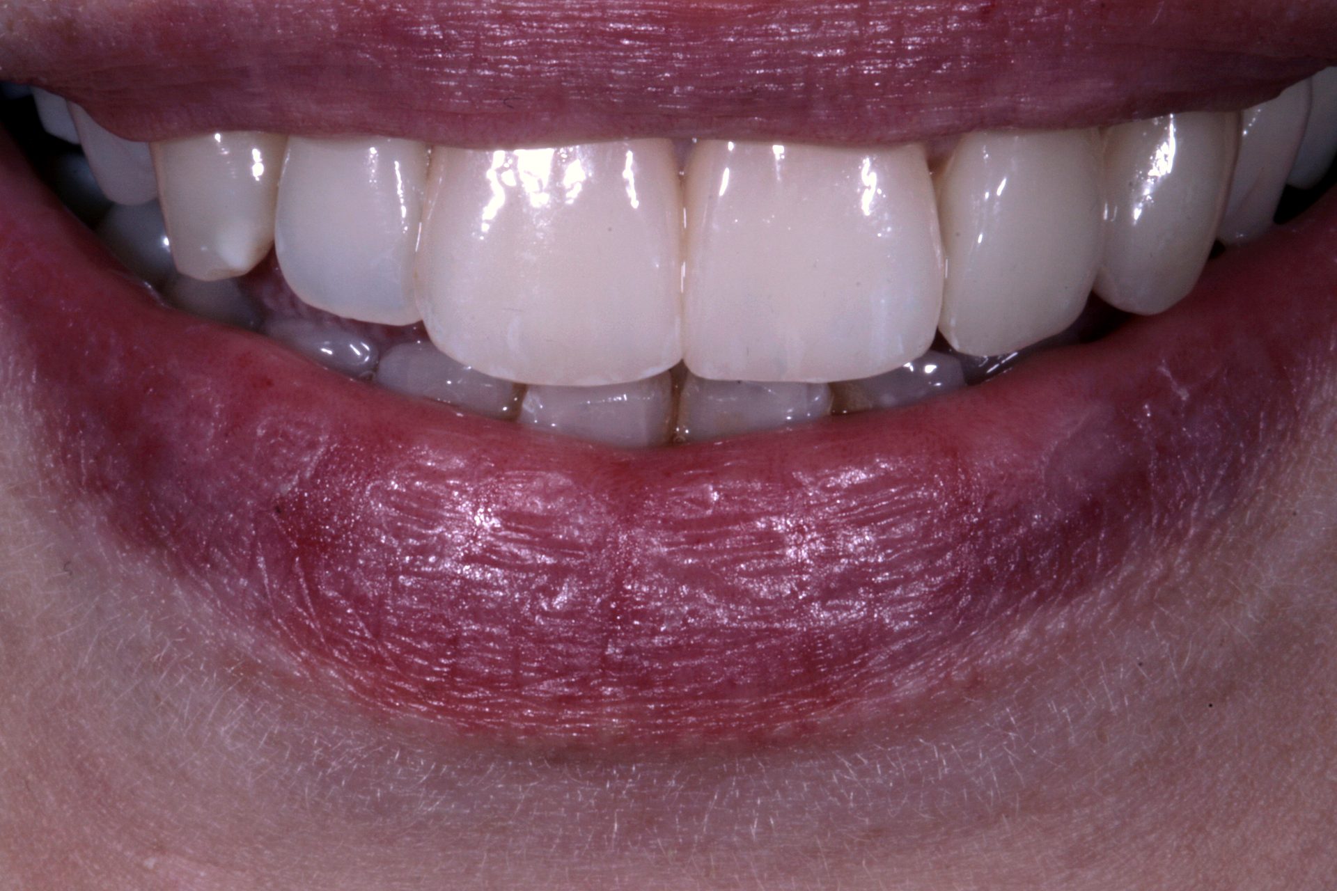 Dopo — Faccette in ceramica · ceramica integrata