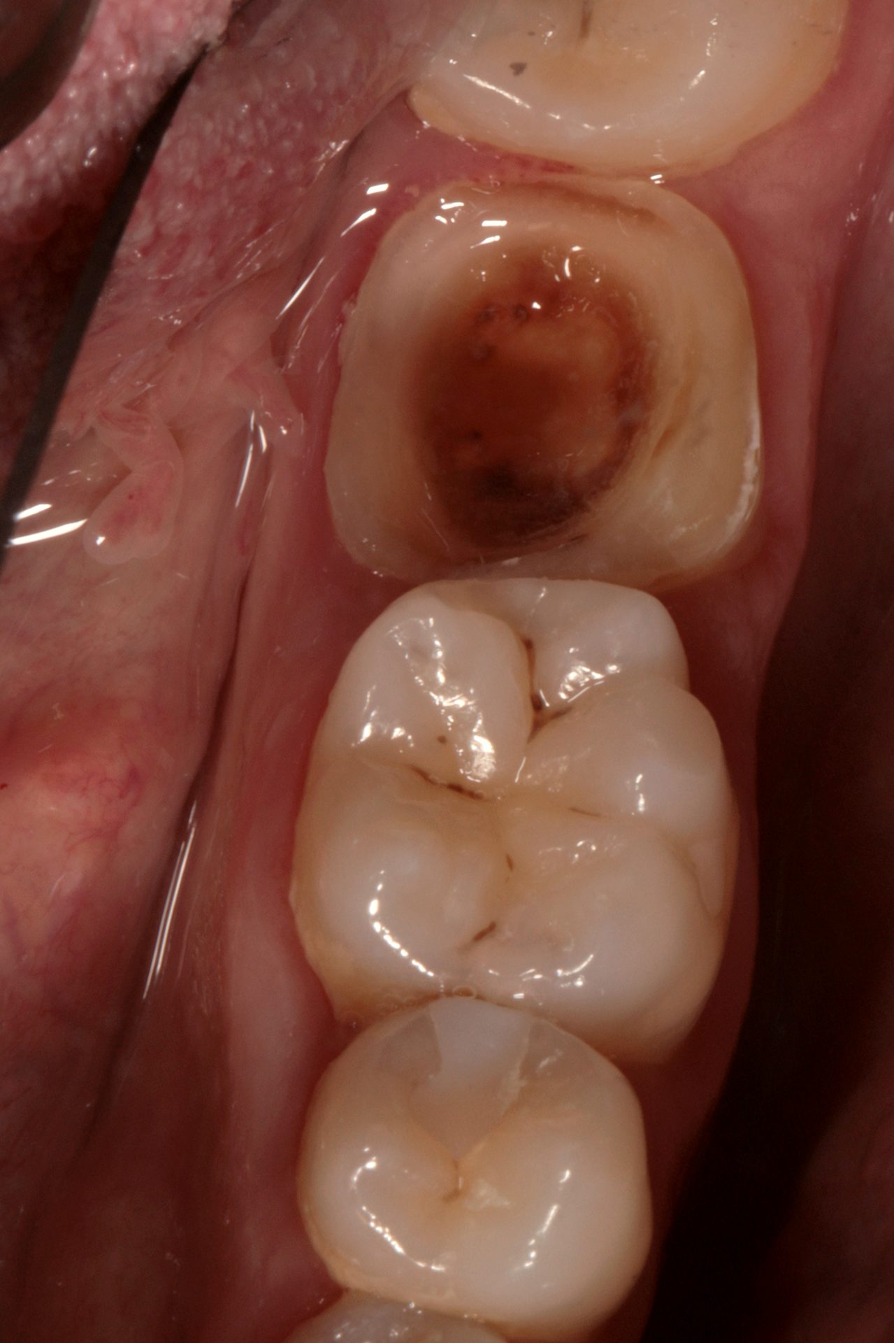 Prima — Intarsio · caso clinico Dental3N