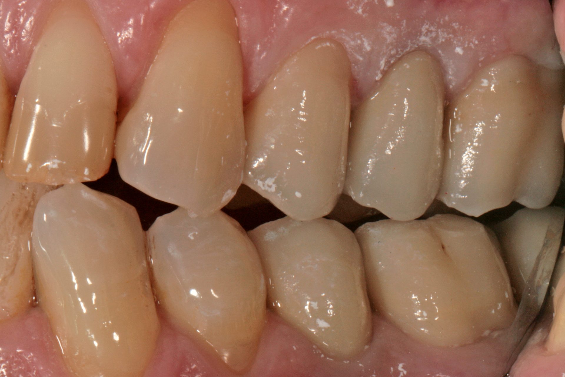 Prima — Corone in ceramica · CAD/CAM