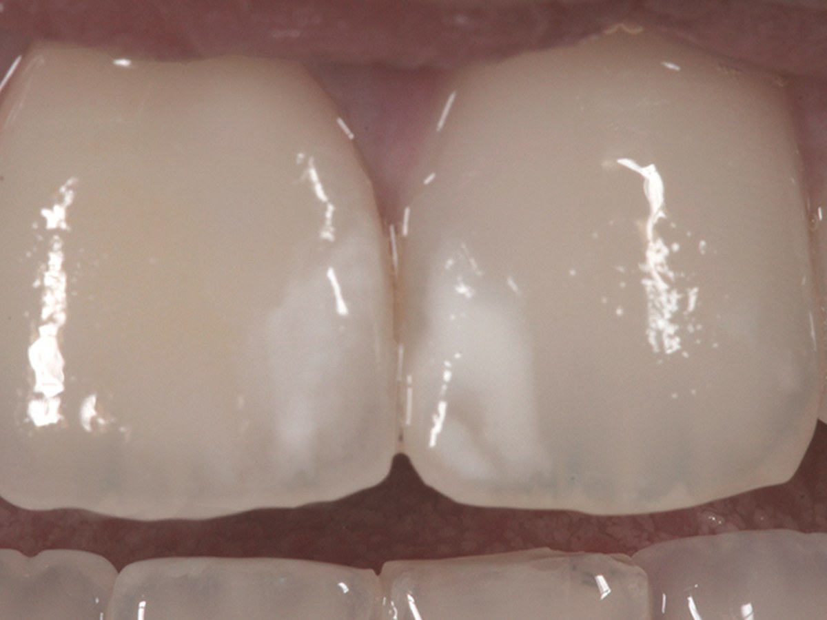 Dopo — Corona singola in ceramica · CAD/CAM