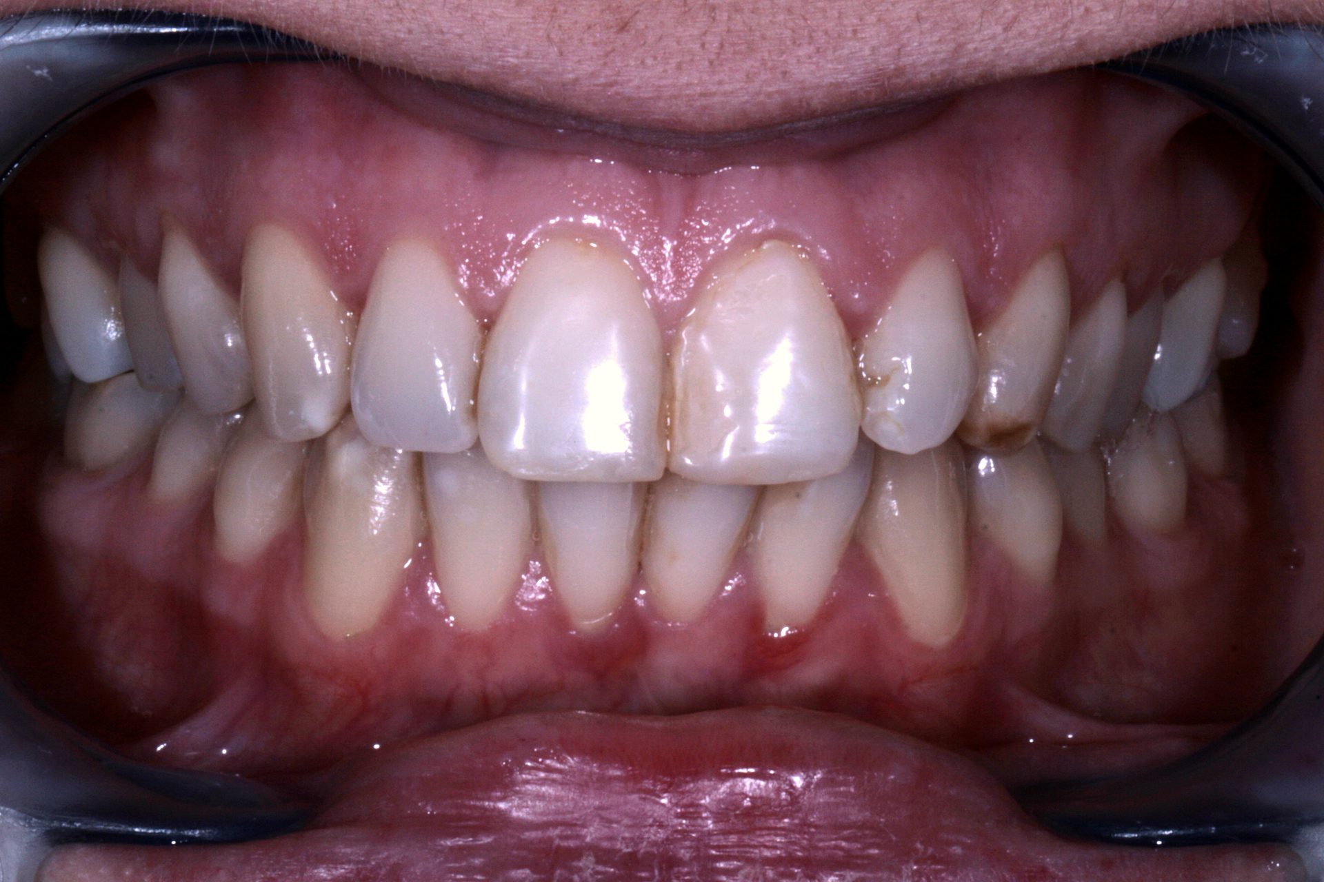 Prima — Faccette in ceramica · ceramica integrata