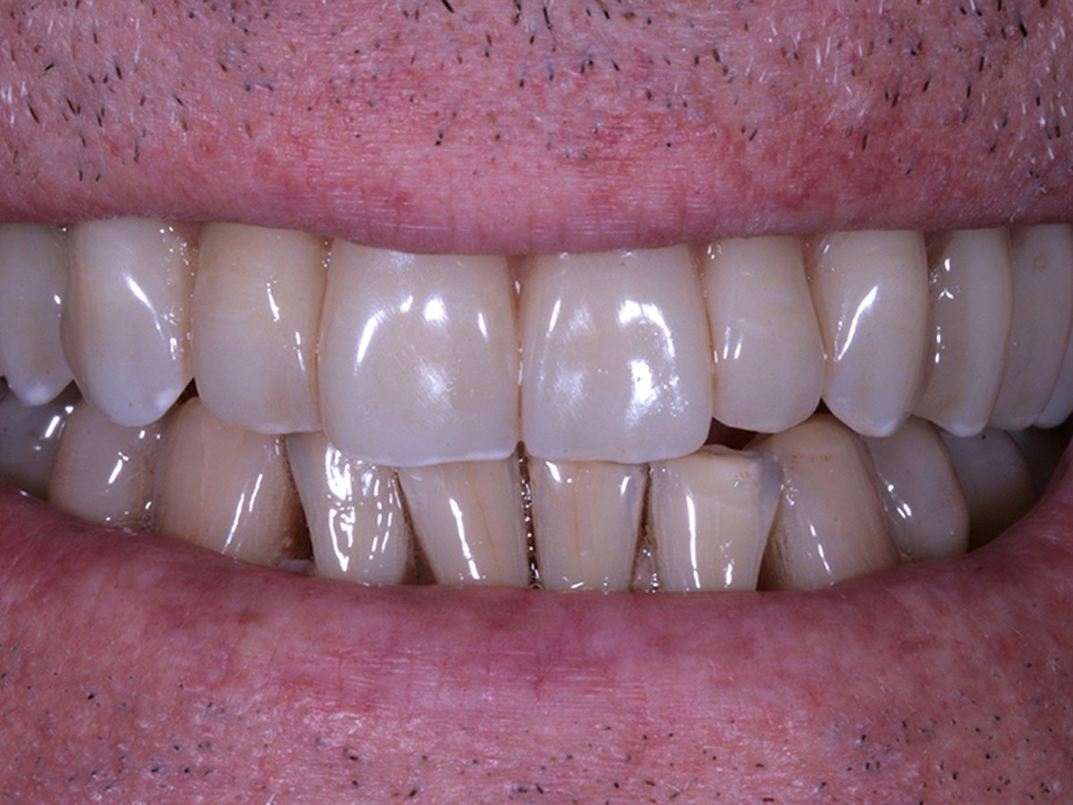 Dopo — Riabilitazione implantare · filiera interna