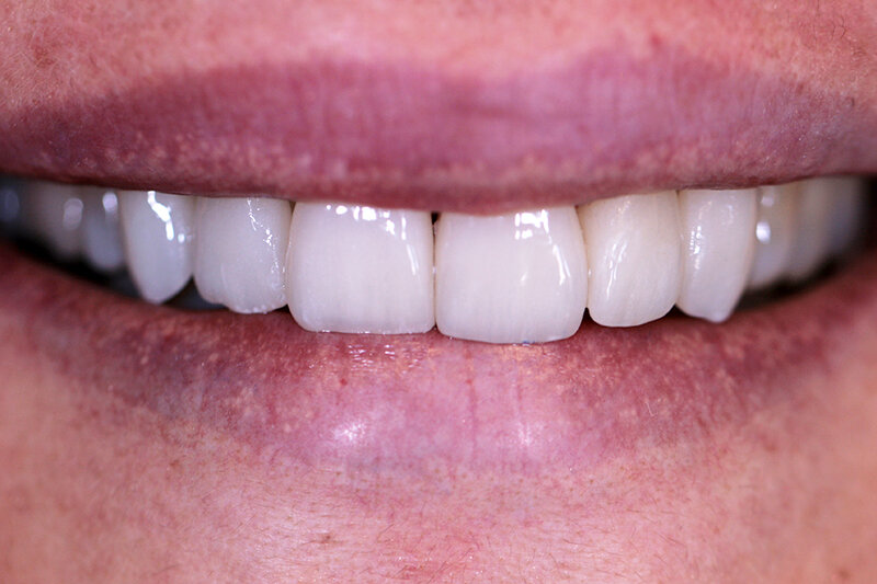 Dopo — Faccette · naturalezza del sorriso